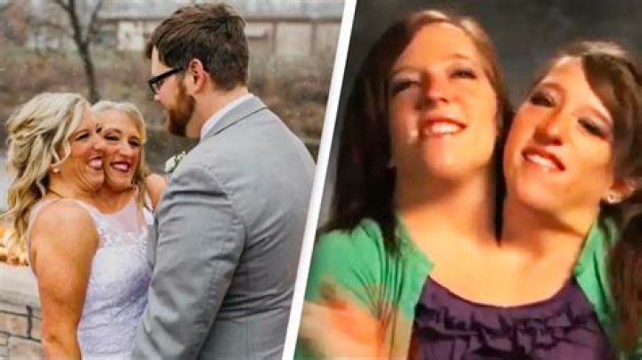 Conjoined Twins Get Married: A Unique Love Story