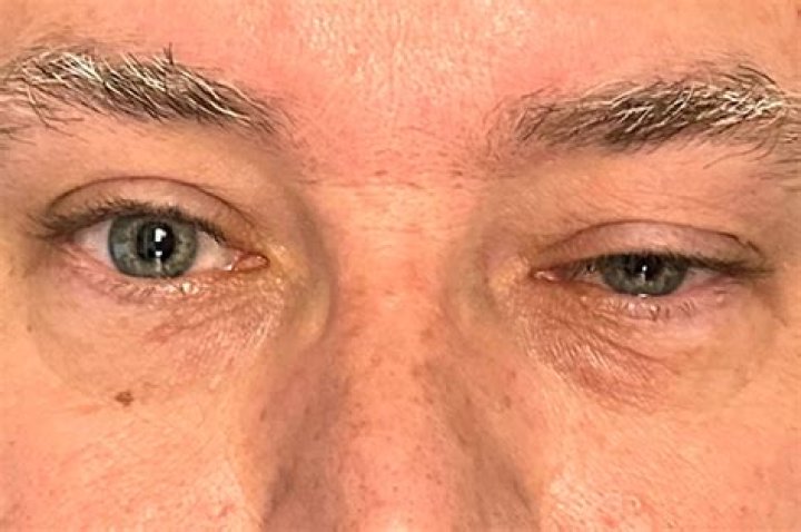 Exploring the Impact of Steve Liesman's Eye Injury: A Detailed Insight