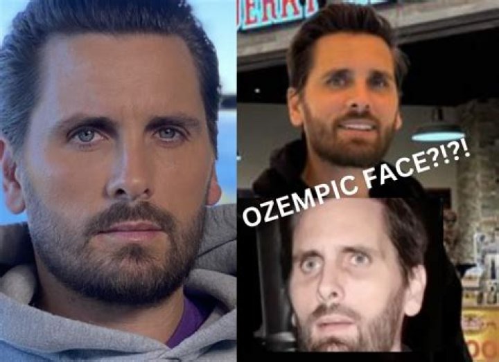 Scott Disick's Ozempic Face Transformation: Unveiling the Truth Behind the Trend