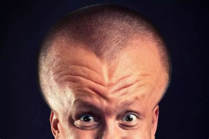 Unbelievable! Biggest Forehead in the World Revealed!