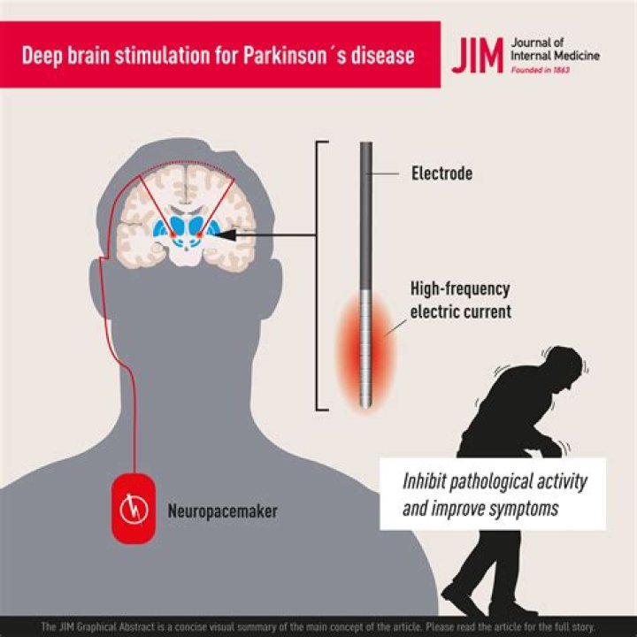 Understanding Jimmy Smits and His Journey with Parkinson's Disease